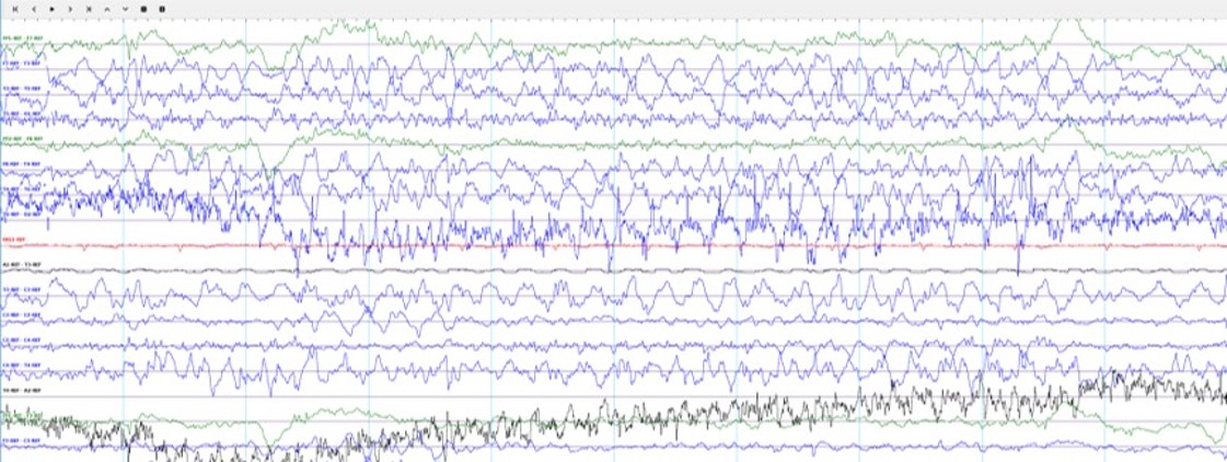 Typical EEG Signals